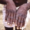 About the monkeypox virus